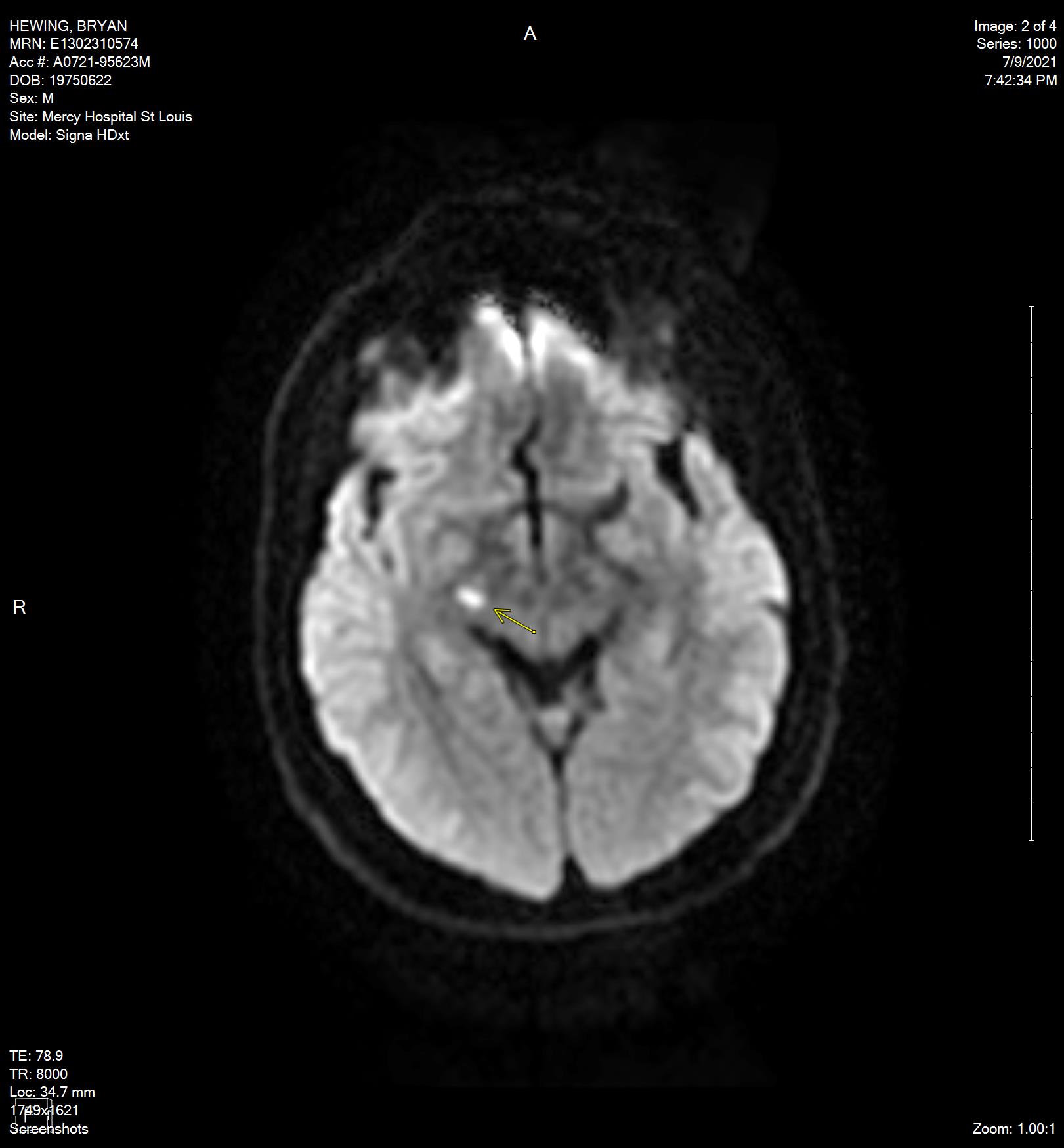 My Stroke Story Update…..Here We Go Again!